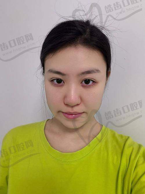 广州广大整形医院徐威强医生下颌角手术3万元起，微创自然，术后恢复快 