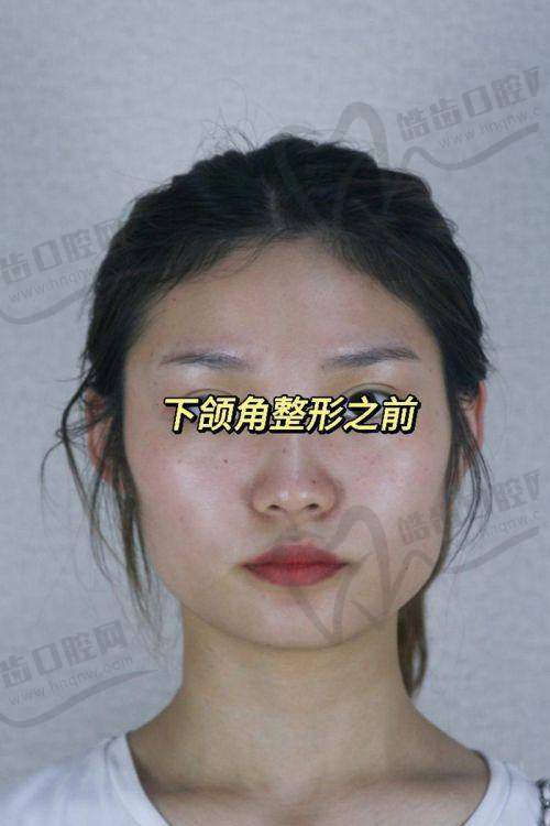 五、徐威强医生下颌角手术口碑展示