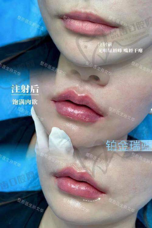 北京安贞医院勾涛医生注射微调都有哪些？