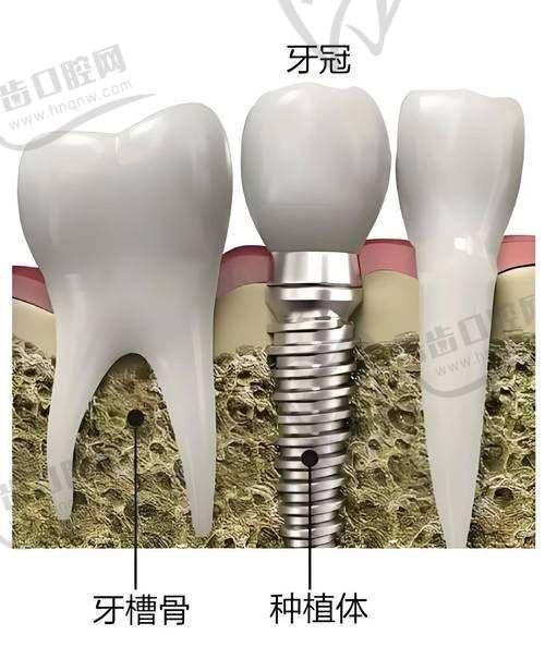 与其他医院种植牙的对比优势