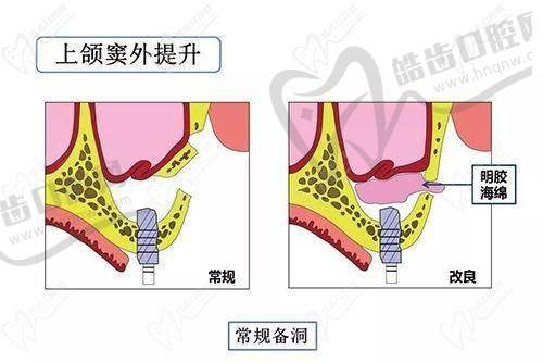上颌窦提升术修复期的阶段划分与护理重点