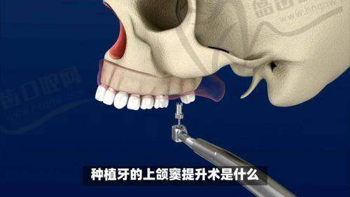 1. 急性反应期（术后1 - 3天）