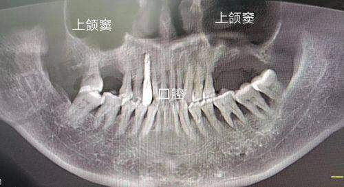 4. 稳定修复期（术后16 - 30天）