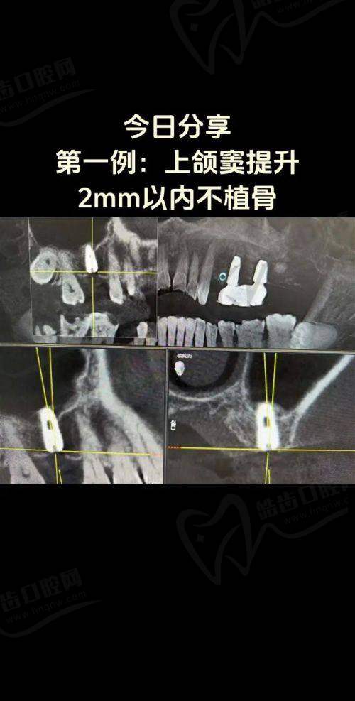 2. 肿胀与淤青：面部变形的困扰