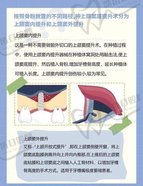 上颌窦提升术后15天的饮食管理与营养建议