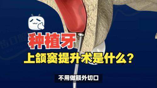 上颌窦提升术后口腔清洁的特殊方法与注意事项