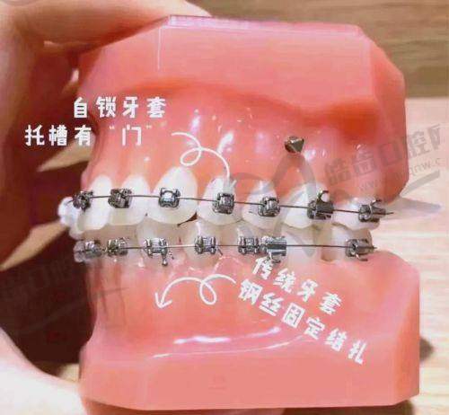 金属自锁矫正的过程是怎样的？