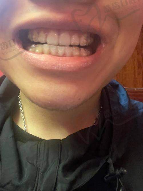 正雅隐形矫正的优势有哪些？