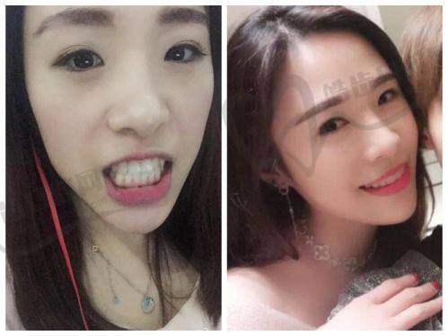 正雅隐形矫正是什么？