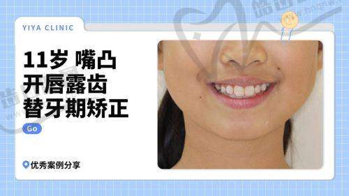 3. 咬合状态监控：定期自查及时发现异常