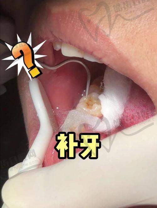 德州可恩口腔医院儿童3MP60树脂补牙美观性优势