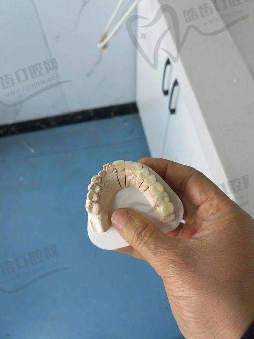 为什么选择德州可恩口腔的爱尔创二氧化锆牙冠？