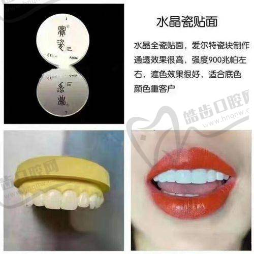 清远粤美口腔超薄贴面价格体系