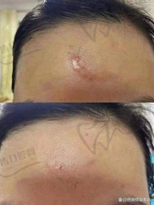 黄威医生祛疤+整形项目组合费用曝光