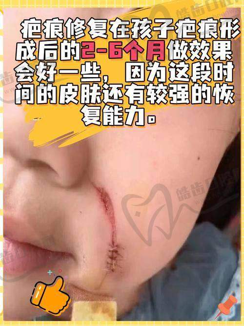 沈阳黄威医生——双眼皮修复手术多少钱？