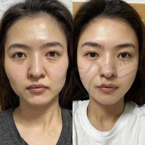 二、蒙石南医生小切口拉皮手术价格解析