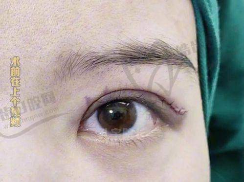 张莹莹双眼皮修复手术风格如何？