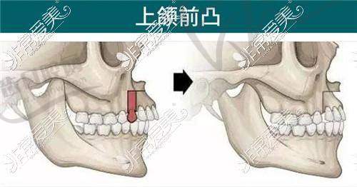 动作三：“咬合垫辅助”训练（需医生定制咬合垫）