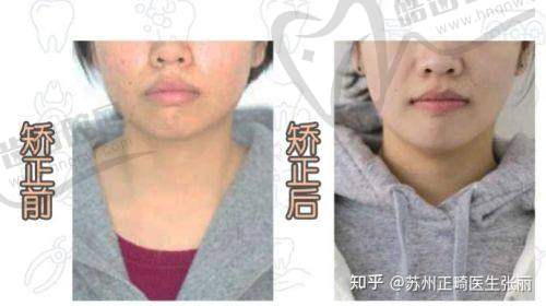 误区三：只矫正牙齿不改善骨骼