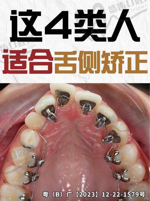 什么是舌侧矫正？