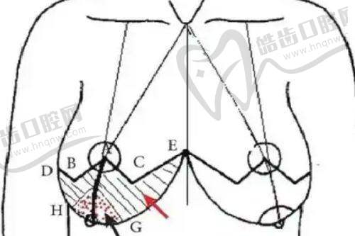 深圳曹孟君医疗美容医院胸部抽脂费用多少？技术优势与多元价格体系揭秘 