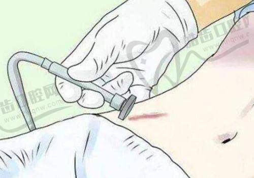 梁伟中全眼周复位价格解析：基础款到尊享款一目了然