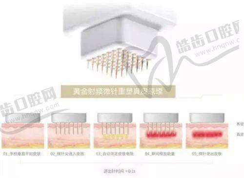 黄金微针嫩肤项目优势