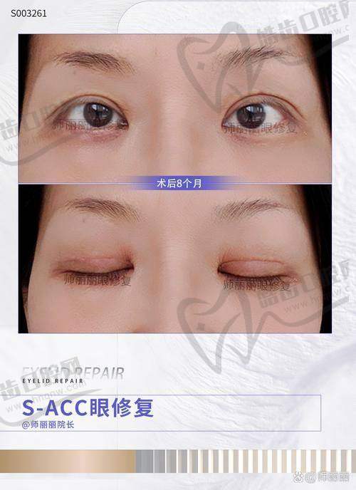 曾宪猛医生技术优势