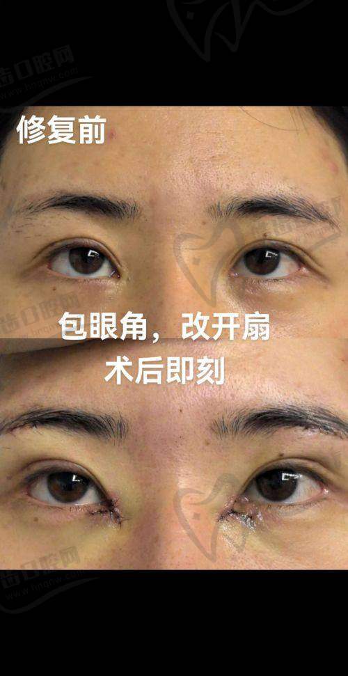 眼部修复技术核心：三大术式加持，闭眼自然0痕