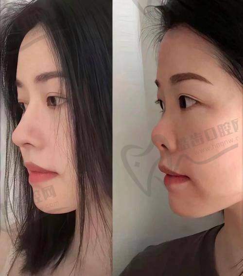 黄烈文擅长做哪种风格的鼻子？肋骨鼻、妈生感、自然挂一个都不少！