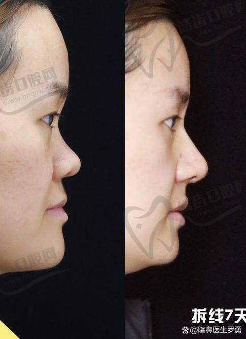 黄烈文值不值得去做鼻子？看顾客真实反馈告诉你答案