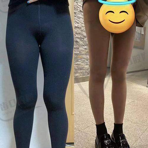 五、昆明韩辰王德宁大腿吸脂项目价格