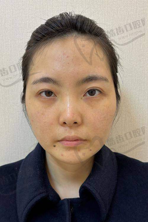 王玉燕医生在微整注射领域的专长