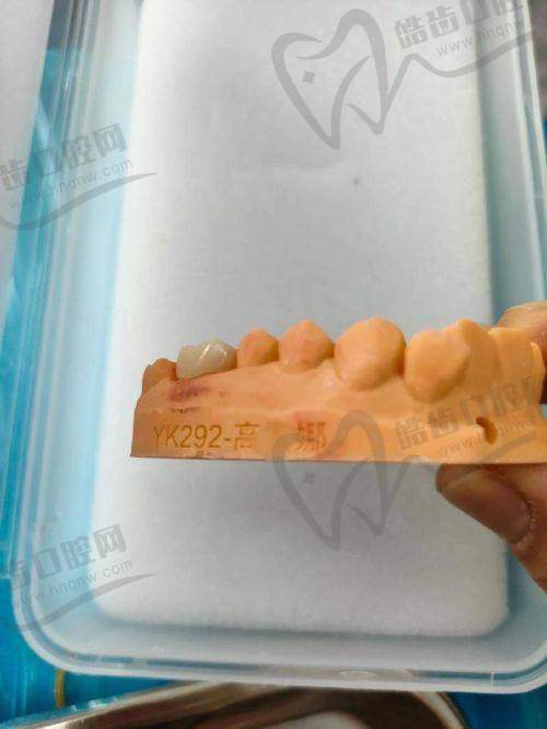 在郴州植贝尔口腔医院带牙套的其他费用