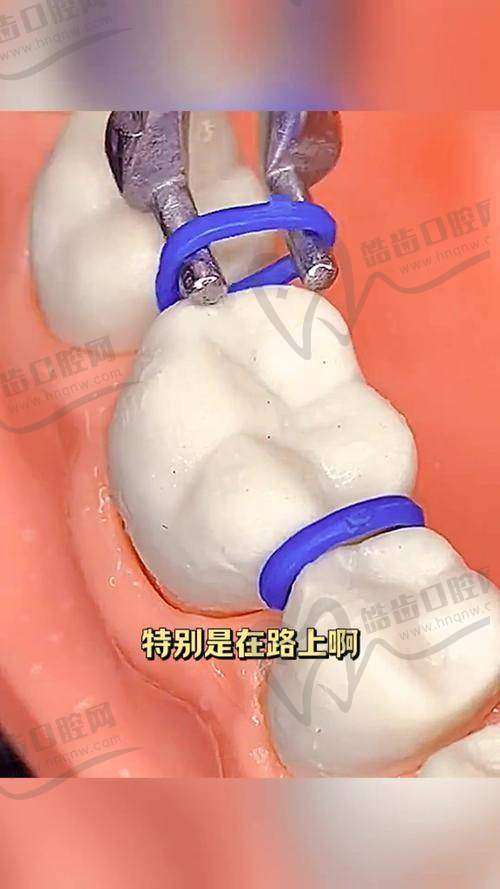 郴州植贝尔口腔医院牙套价格的影响因素