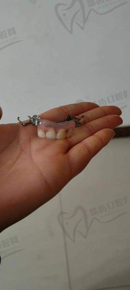 珠海诺贝尔口腔做国产全瓷冠的优势在哪里？