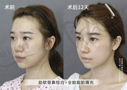 三、彭栋梁鼻部综合整形技术特点