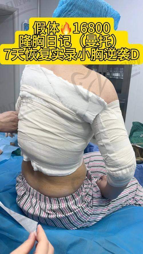 昆明韩辰陈宁曼托假体隆胸项目价格