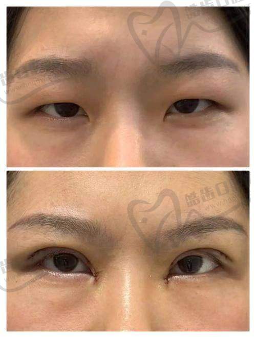 五、邓红英医生双眼皮手术口碑展示