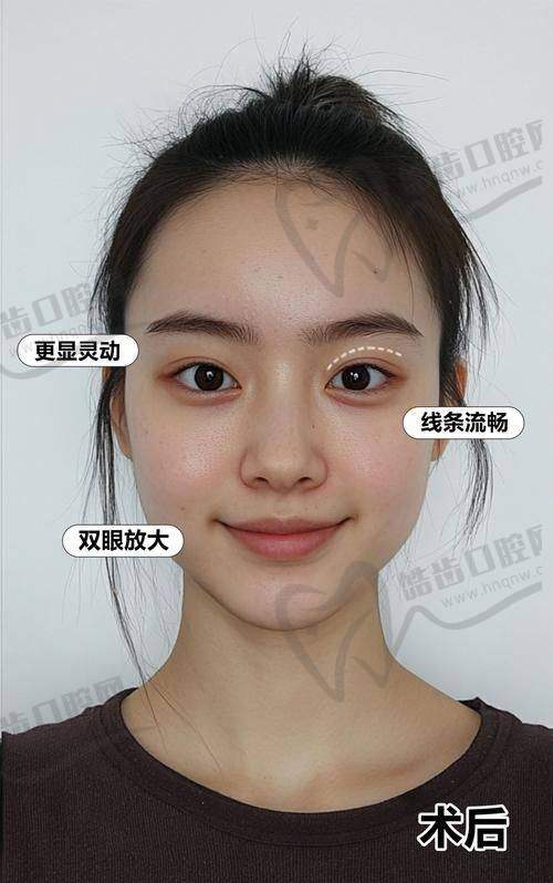 四、邓红英医生双眼皮手术的独特优势