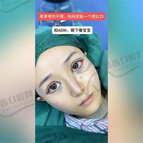 三、邓红英医生双眼皮手术优势技术盘点