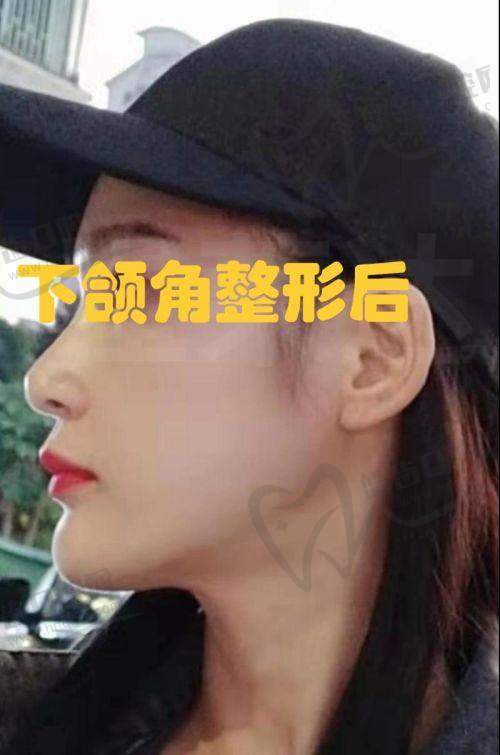 北京小忠丽格鼻小柱延长 20750 元起，正规医美机构口碑好效果优值得选 