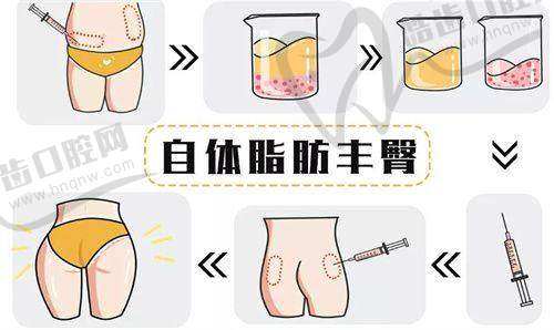 深圳富华5d童颜术玻尿酸材料的优势