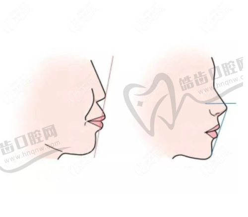 隐形矫正：悄悄变得更美的秘密武器
