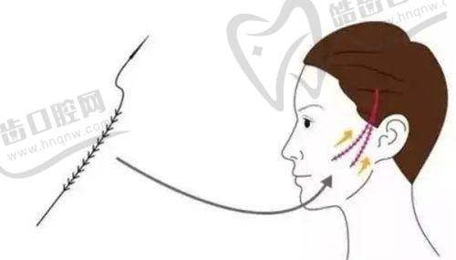深圳富华5d童颜术是用什么做的？靠多维抗衰技术解析所用的核心材料