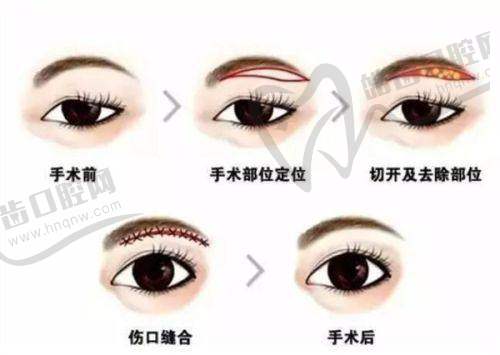 张楚医生简介：上海眼部修复界的“救场王”
