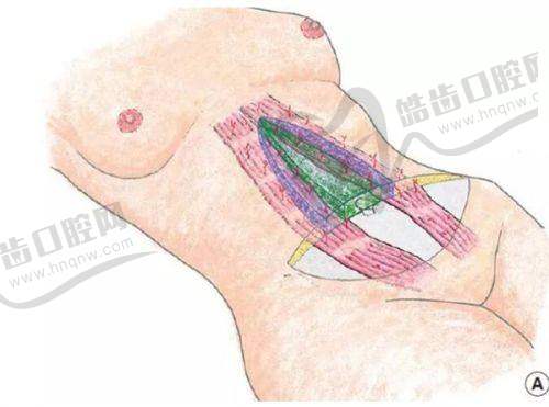 上海郑小红双眼皮修复实例展示