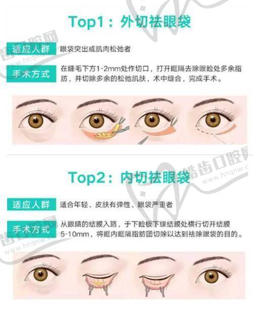 郑小红医生双眼皮手术的实例成效