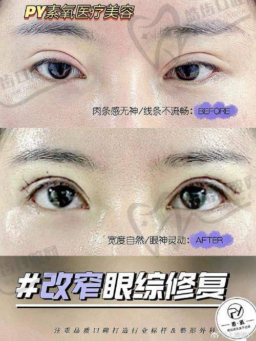 选择郑小红医生做双眼皮的价格与避坑指南