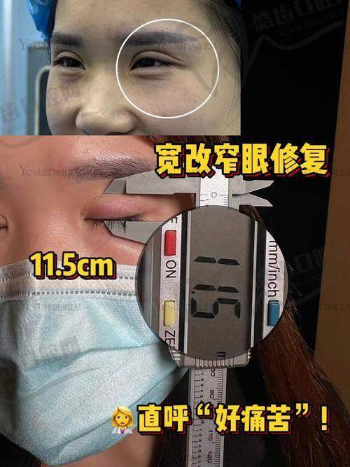 同行对比：郑州其他眼整形医生一览